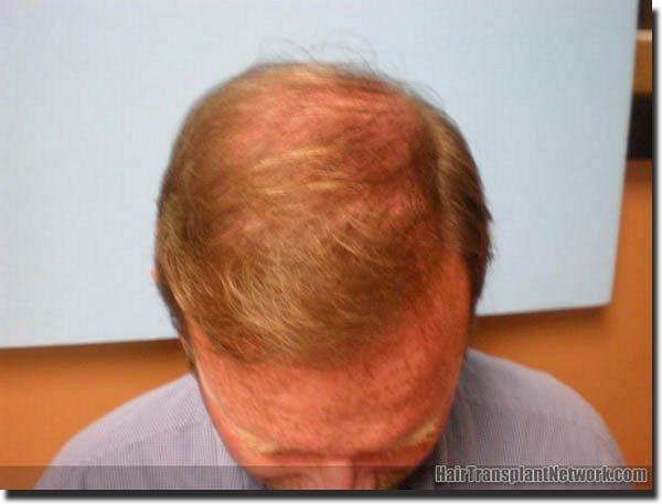 Hair restoration procedure results