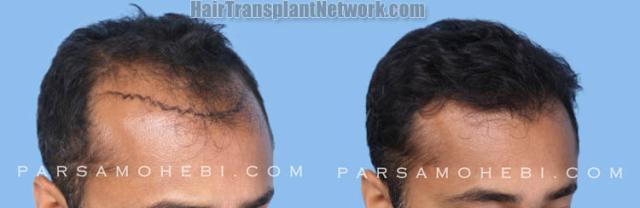 FUE  before and after photos