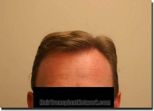 Hair restoration procedure results