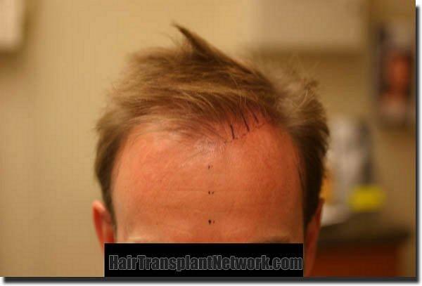 Hair restoration procedure results