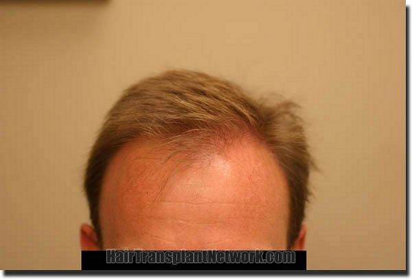 Hair restoration procedure results