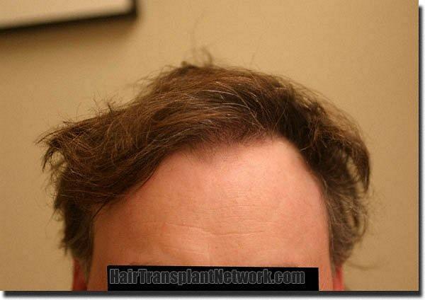 Hair restoration procedure results