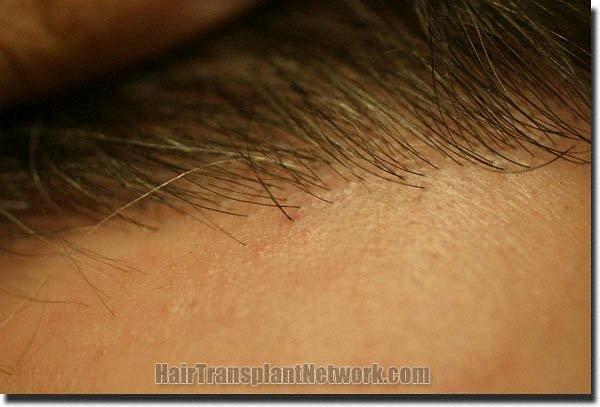 Hair restoration procedure results