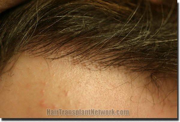 Hair restoration procedure results