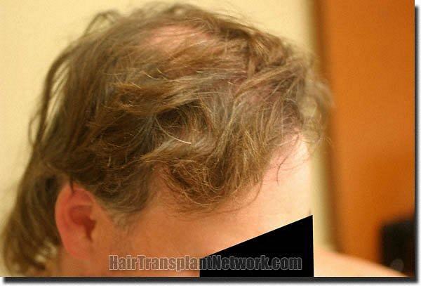 Hair restoration procedure results