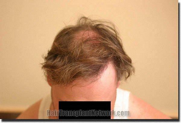 Hair restoration procedure results