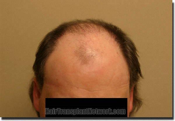 Hair restoration procedure results