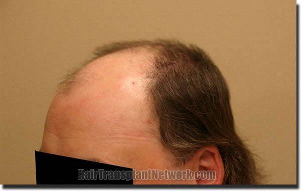 Hair restoration procedure results