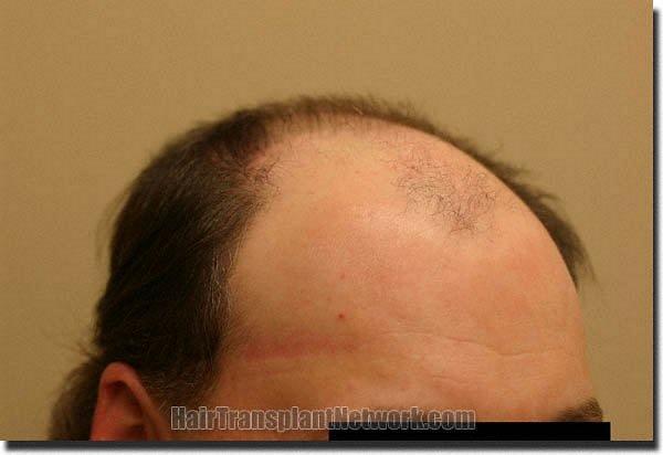 Hair restoration procedure results