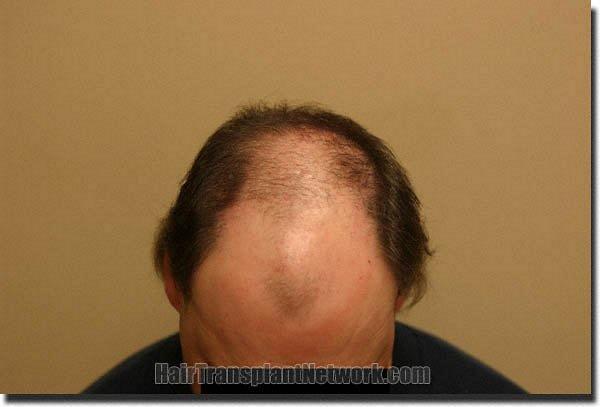 Hair restoration procedure results