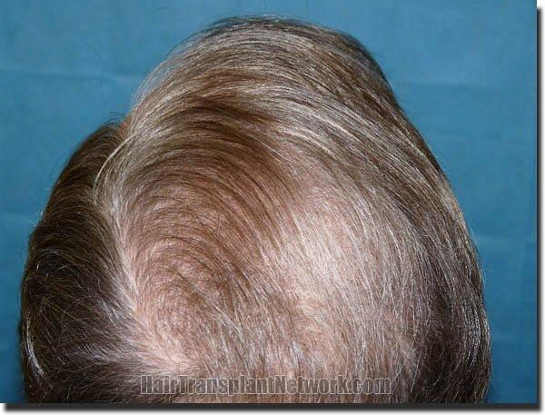 Hair restoration procedure results