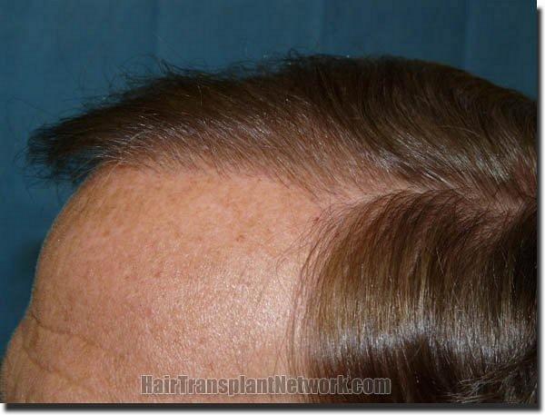 Hair restoration procedure results