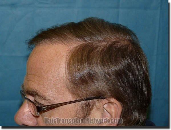 Hair restoration procedure results