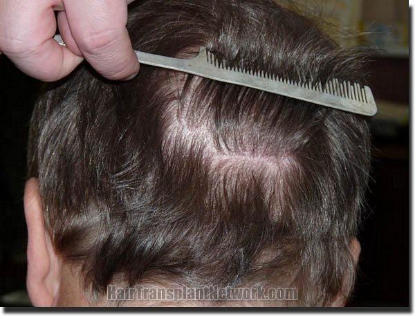 Hair restoration procedure results