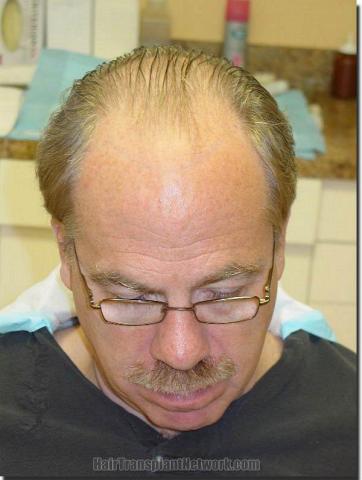 Hair restoration procedure results