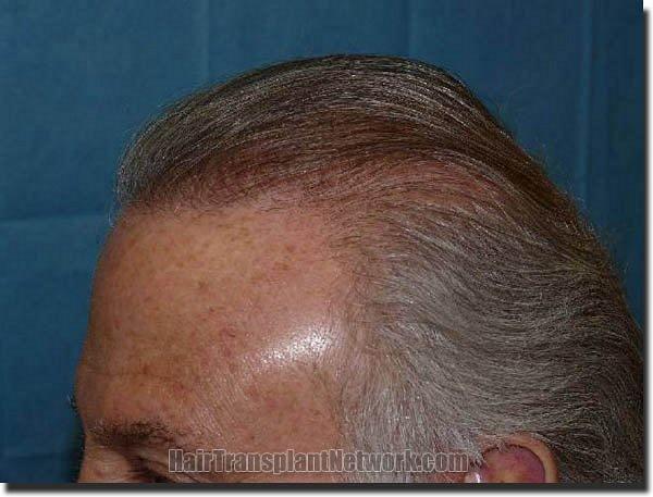 Hair restoration procedure results