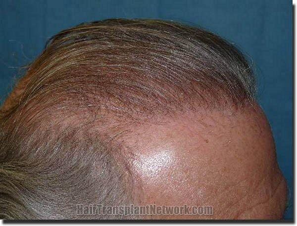 Hair restoration procedure results