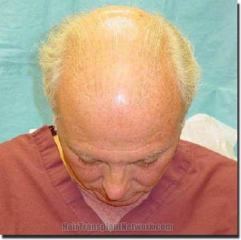 Hair restoration procedure results