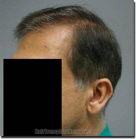 Hair restoration procedure results