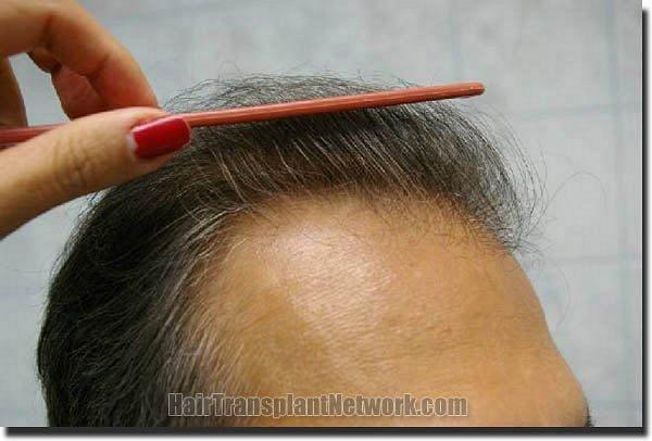 Hair restoration procedure results