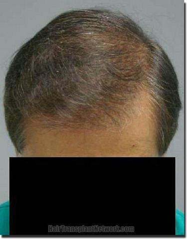 Hair restoration procedure results