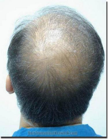 Hair restoration procedure results