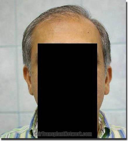 Hair restoration procedure results