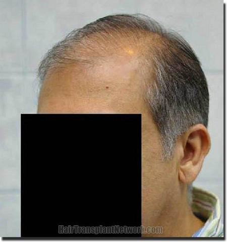 Hair restoration procedure results