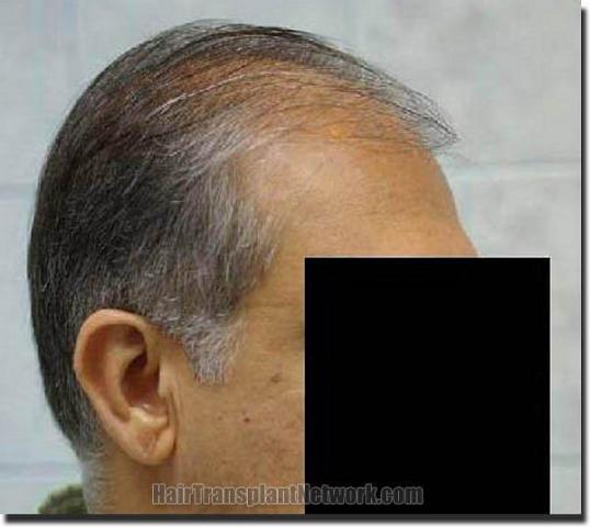 Hair restoration procedure results