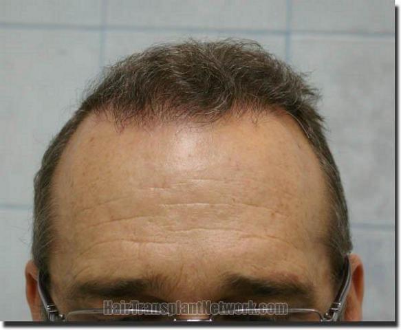 Hair restoration procedure results