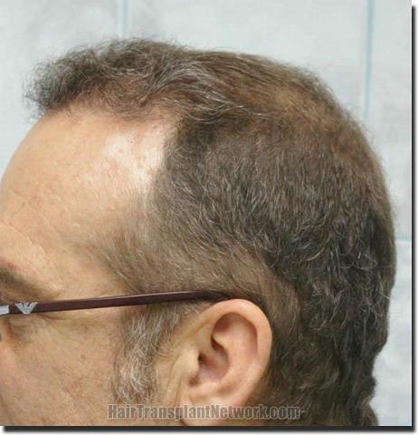 Hair restoration procedure results