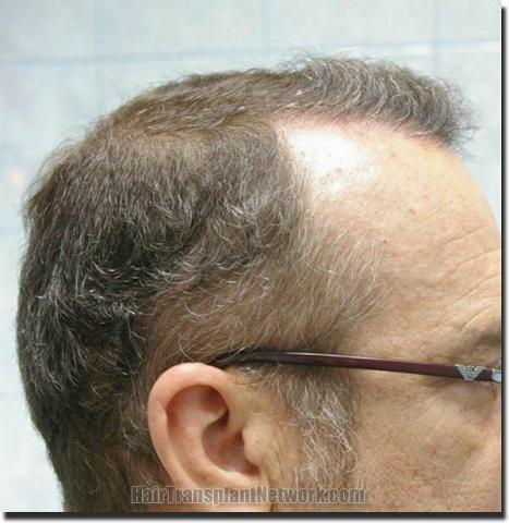 Hair restoration procedure results