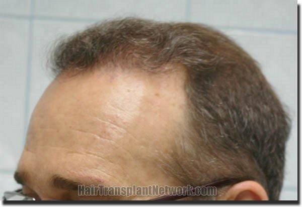 Hair restoration procedure results