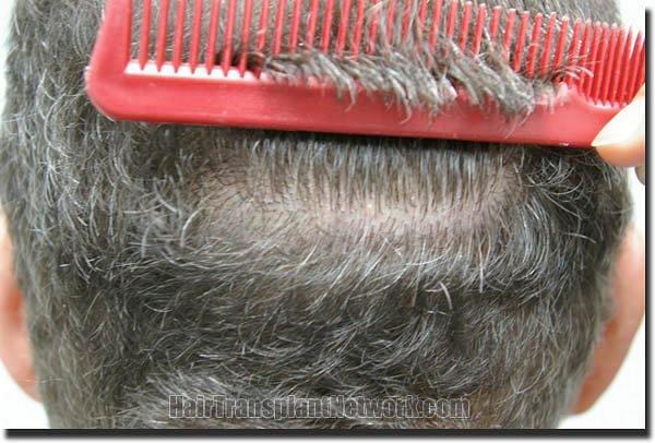 Hair restoration procedure results