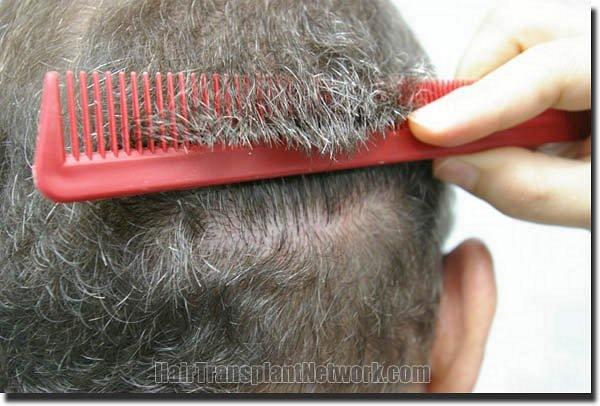 Hair restoration procedure results