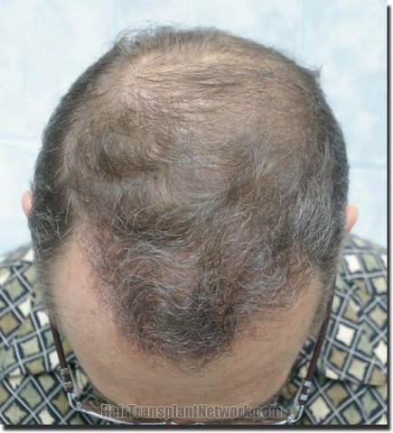 Hair restoration procedure results