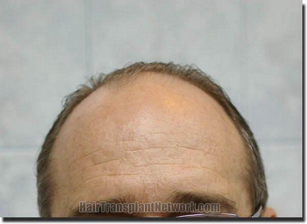 Hair restoration procedure results