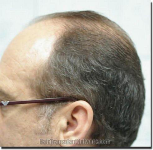 Hair restoration procedure results