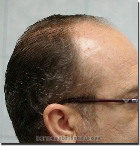 Hair restoration procedure results