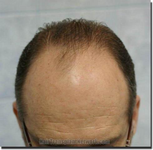 Hair restoration procedure results