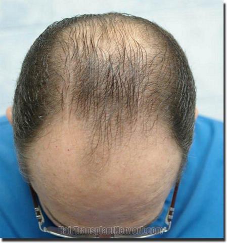 Hair restoration procedure results