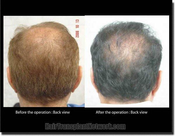 Hair restoration procedure results