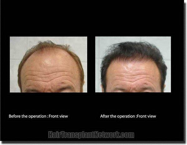 Hair restoration procedure results