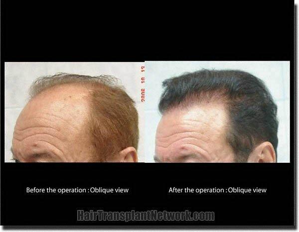 Hair restoration procedure results