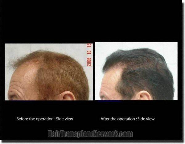 Hair restoration procedure results