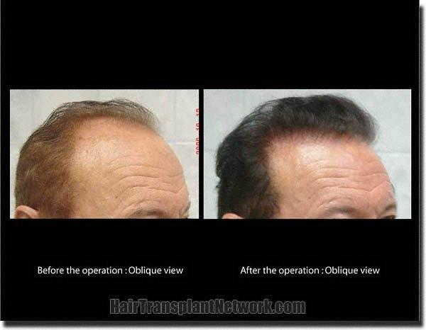 Hair restoration procedure results