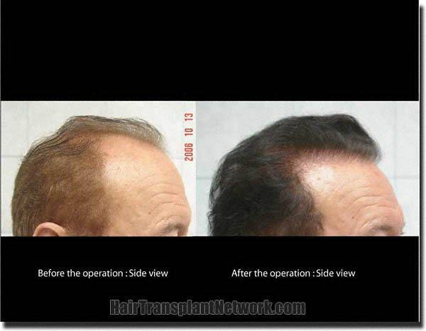 Hair restoration procedure results