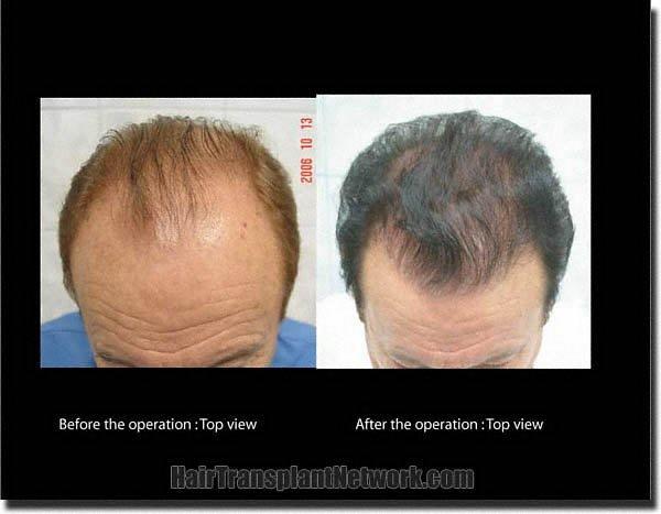 Hair restoration procedure results