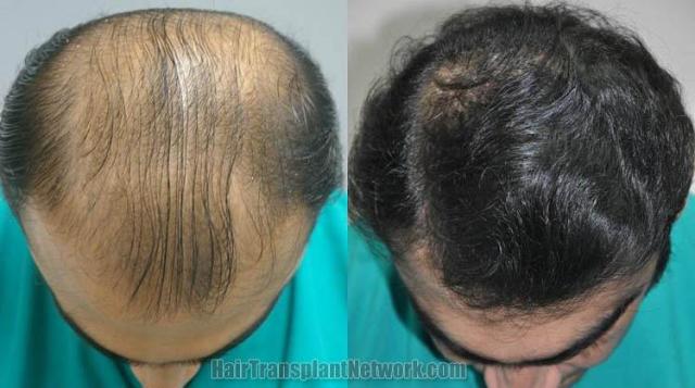 Hair restoration procedure before and after results