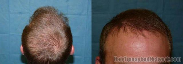 Closeup and back view of hair transplant results